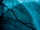 Images of Coronary Arteries on a Screen at a Cardiac Lab