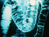 Radiograph of Intestine