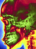 X-ray of Skull With Jaw Wiring
