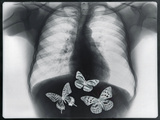 X-ray of butterflies in the stomach