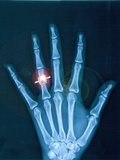 X-ray of hand with diamond ring