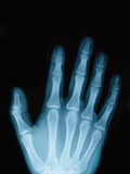 X-Ray of a Hand