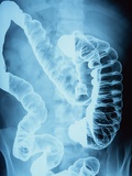 X-Ray of Intestines