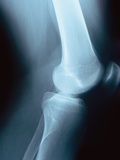 Knee Joint X-Ray