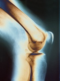 Knee X-ray