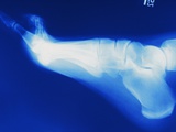 X-Ray of Person's Foot