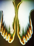 X-ray of Feet