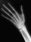 X-ray of a Hand