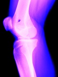 X-Ray of a Knee