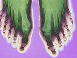 X-ray of Feet