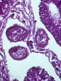 Balantidium Coli Protozoa in the Human Intestine  LM X100