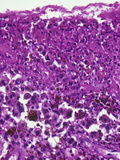 Skin Section from a Patient with Malignant Melanoma  LM X106