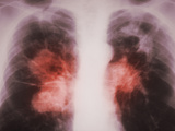 X-Ray of Tuberculosis Calcification Caused by Mycobacterium Tuberculosis Bacteria