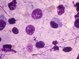 Pneumocystis Carinii Fungus