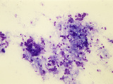 Pneumocystis Carinii Fungus Cysts in the Human Lung  Toluide Blue Stain  LM X110