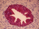 Human Prostate  Prostate Specific Antigen was Labeled with PSA Antibody and Stained Red