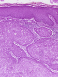 Skin Section from a Patient with Squamous Cell Carcinoma  LM X25