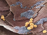 Yeast  Candida Albicans  on Vaginal Epithelium Other Bacteria  Colorized Blue Is also Visible