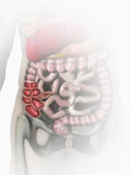 Biomedical Illustration of Crohn's Disease