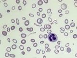 Blood from a Patient with Severe Iron Deficiency Anemia