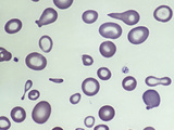 Blood from a Patient with Severe Iron Deficiency Anemia