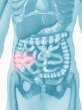 Biomedical Illustration of Inflammatory Bowel Disease (Ibd)