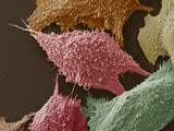 Lung Cancer Cells  SEM
