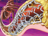 Stent in Coronary Artery of the Heart