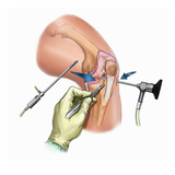 Biomedical Illustration of Parapatellar Stab Incisions (Portals) to Insert Arthroscopic Instruments
