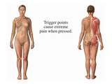 This Medical Exhibit Identifies the Trigger Points Associated with Fibromyalgia Syndrome (Fms)