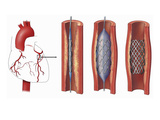 This Stock Image Reveals an Orientation View of the Arteries of the Heart and Three Enlargements